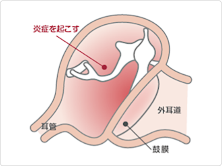 急性中耳炎によって中耳に炎症がおこっているイメージ図