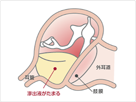 滲出性中耳炎によって中耳に滲出液がたまっているイメージ図
